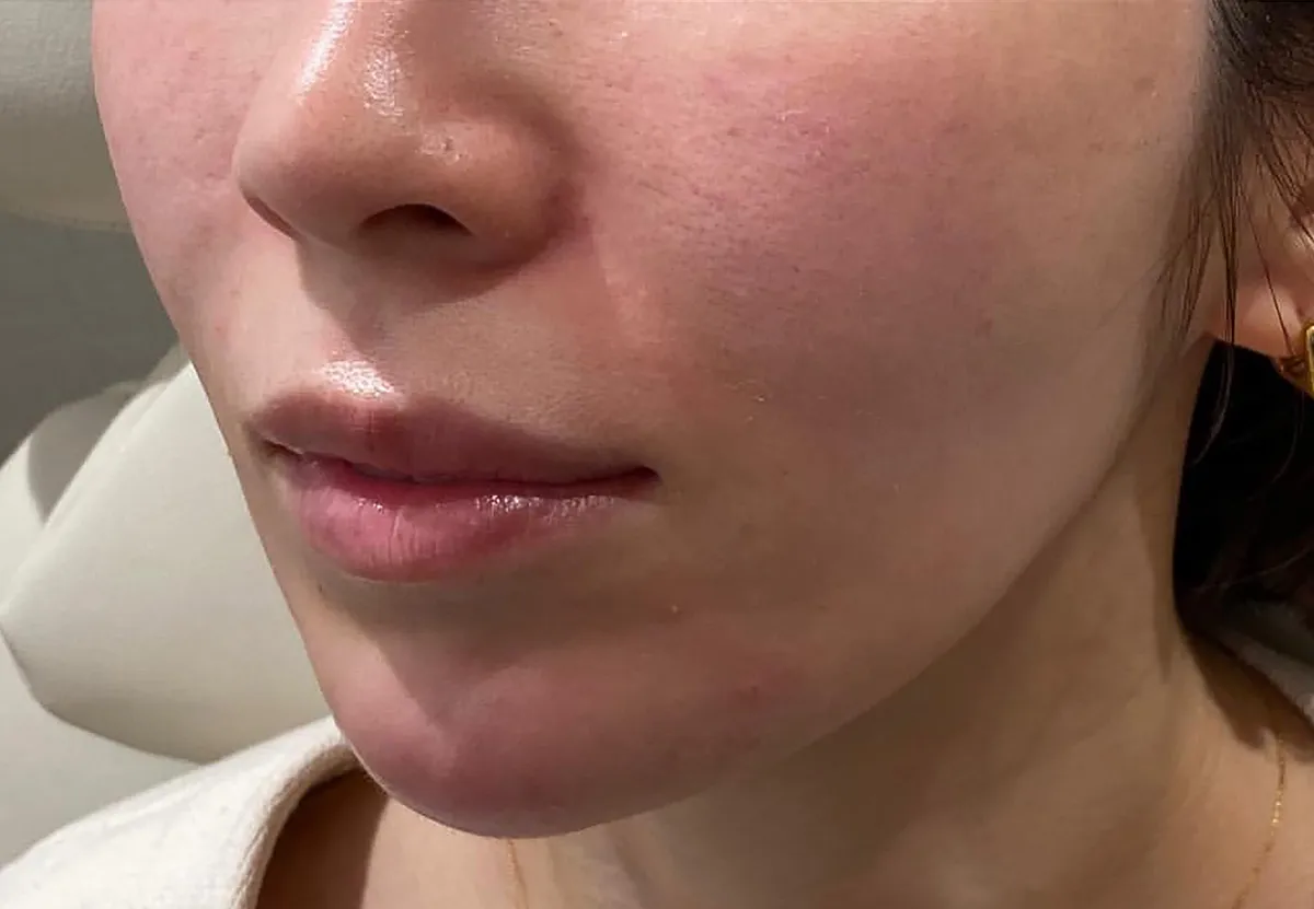 Lower Face Hyaluronic Acid Injection After