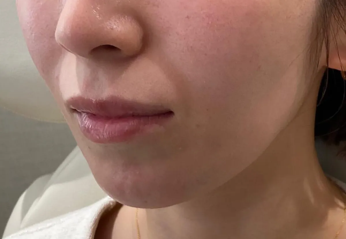Lower Face Hyaluronic Acid Injection Before
