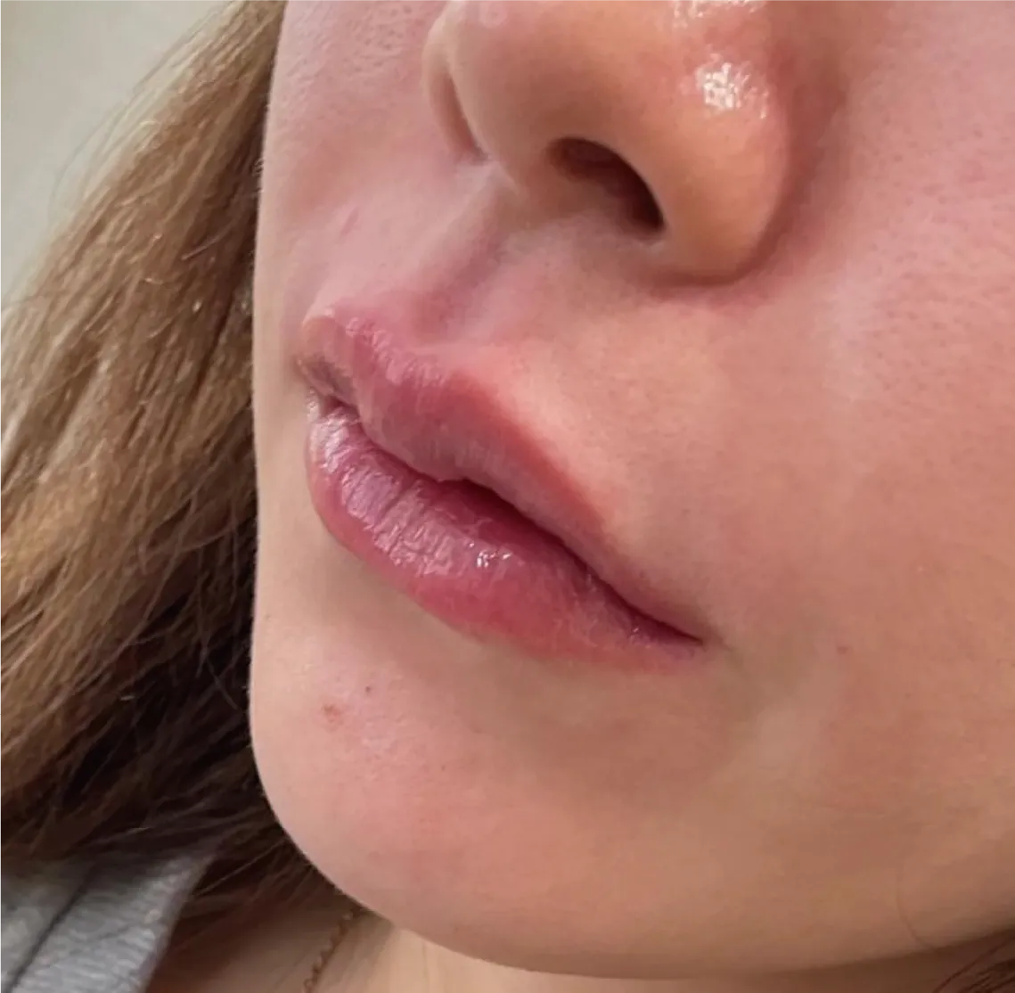 Philtrum Shortening Hyaluronic Acid Injection After