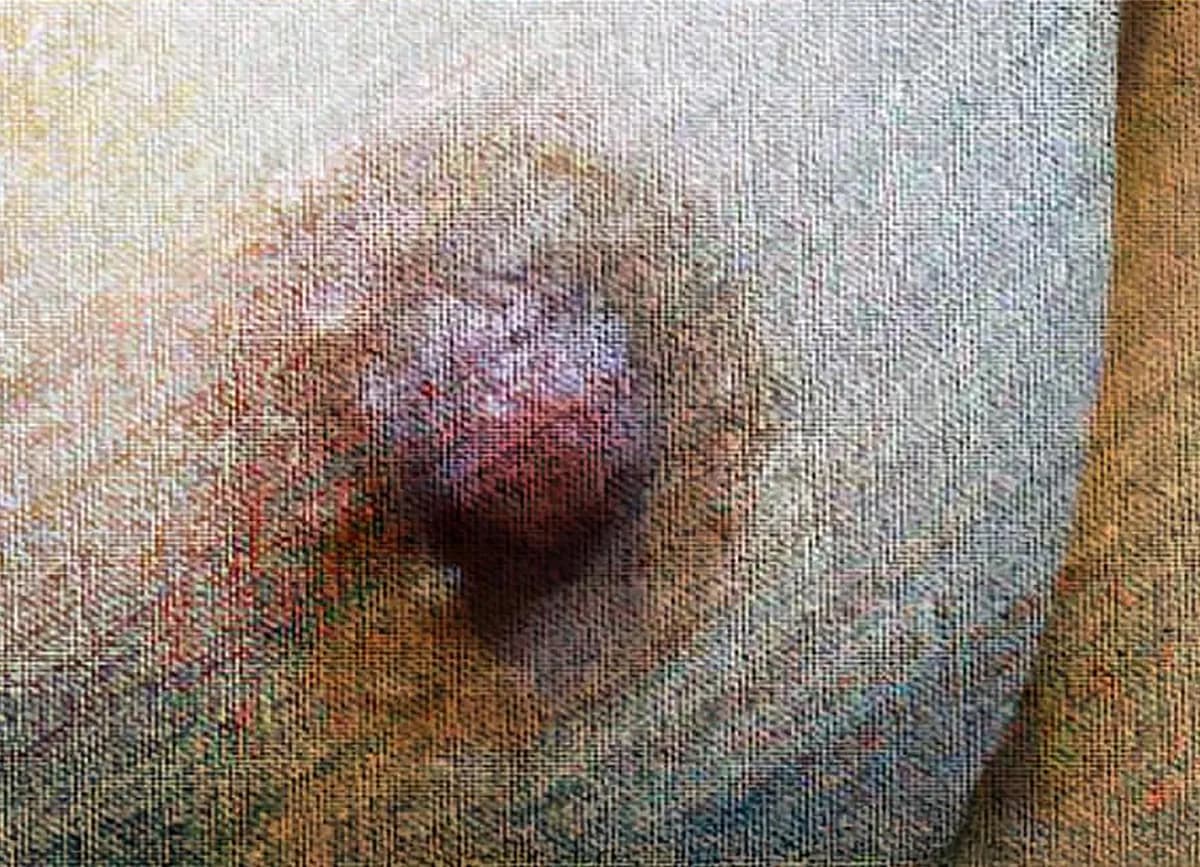 Nipple Reduction After