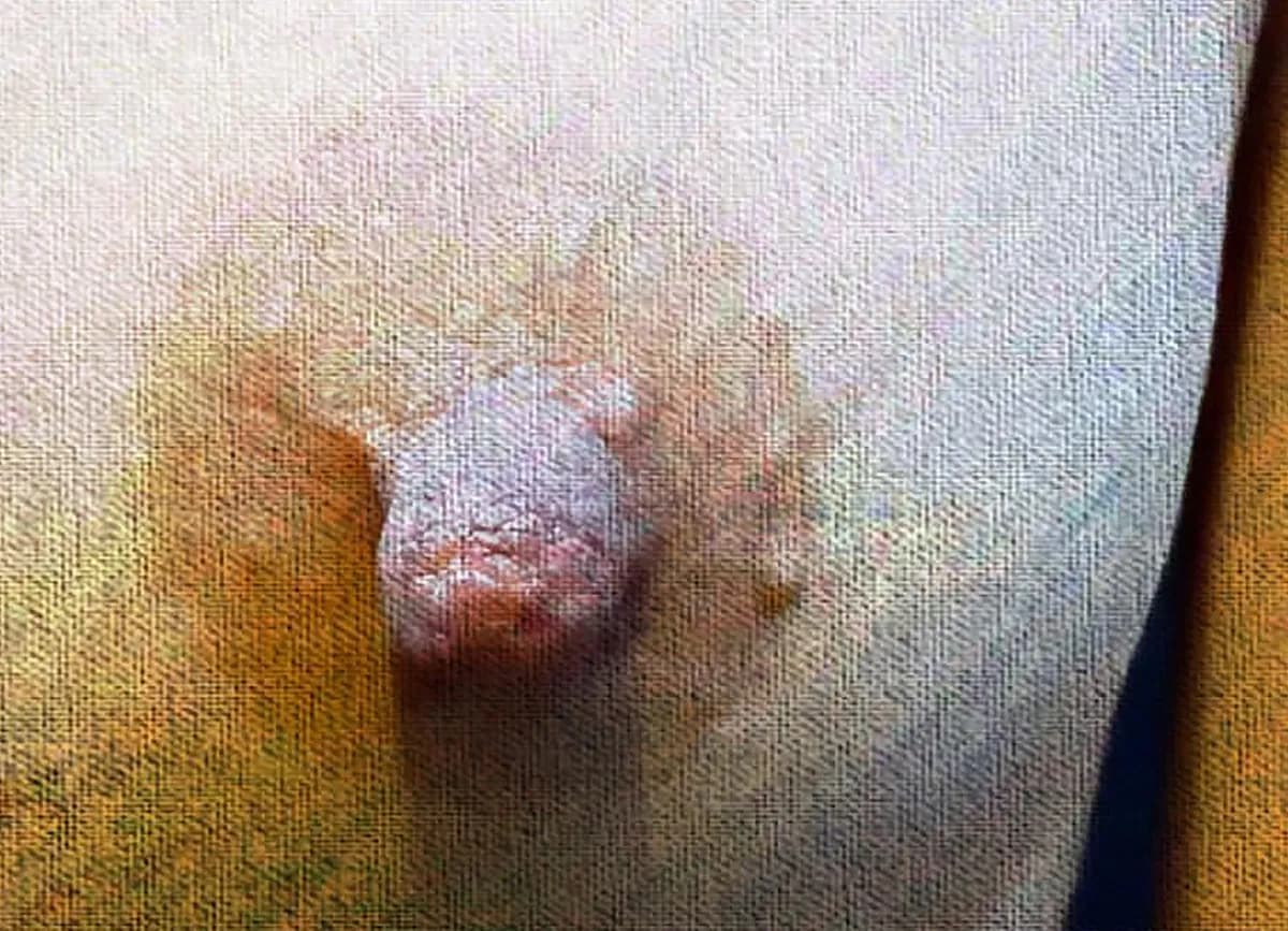Nipple Reduction Before