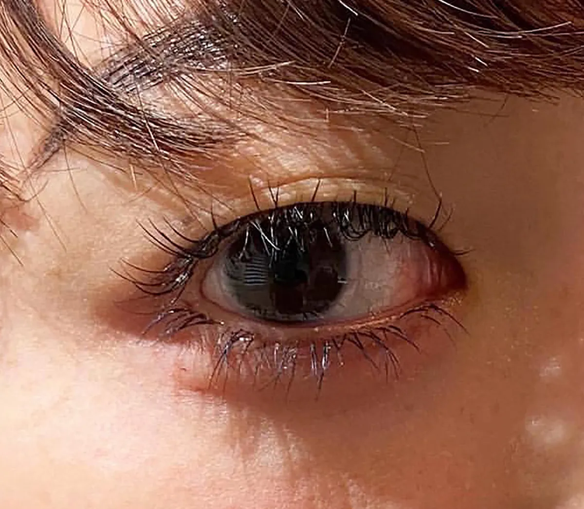 Tear Trough Hyaluronic Acid After
