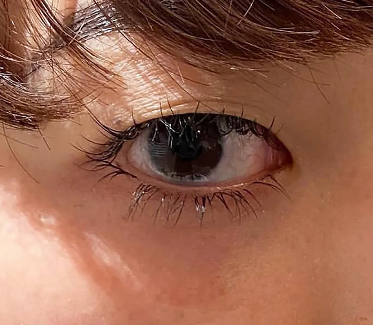 Tear Trough Hyaluronic Acid Before