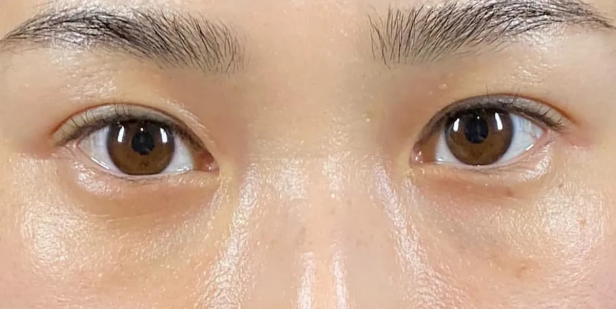 Lower Eyelid Fat Removal Surgery After