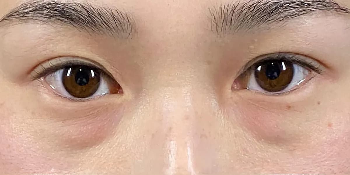 Lower Eyelid Fat Removal Surgery Before
