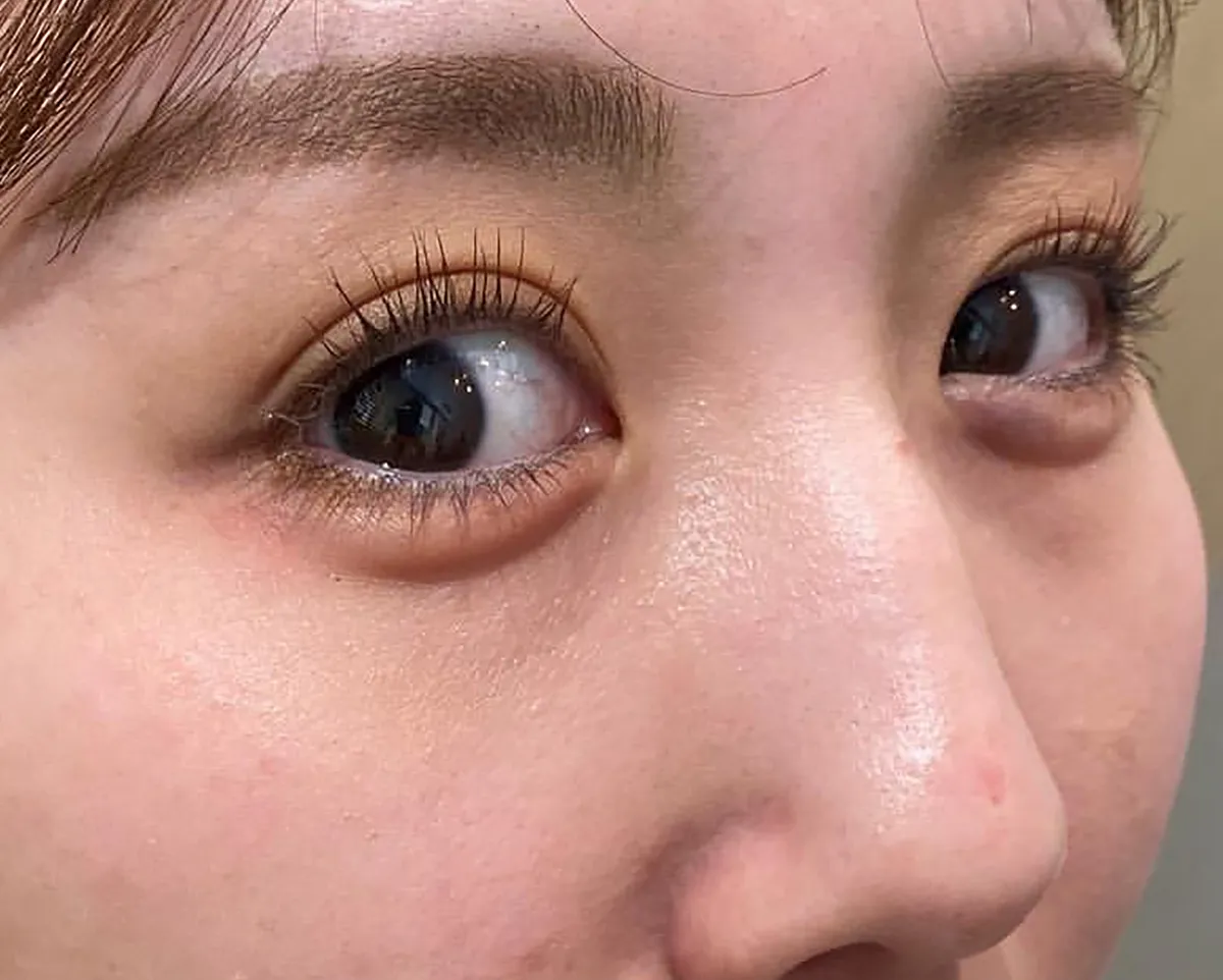 Tear Trough Hyaluronic Acid After