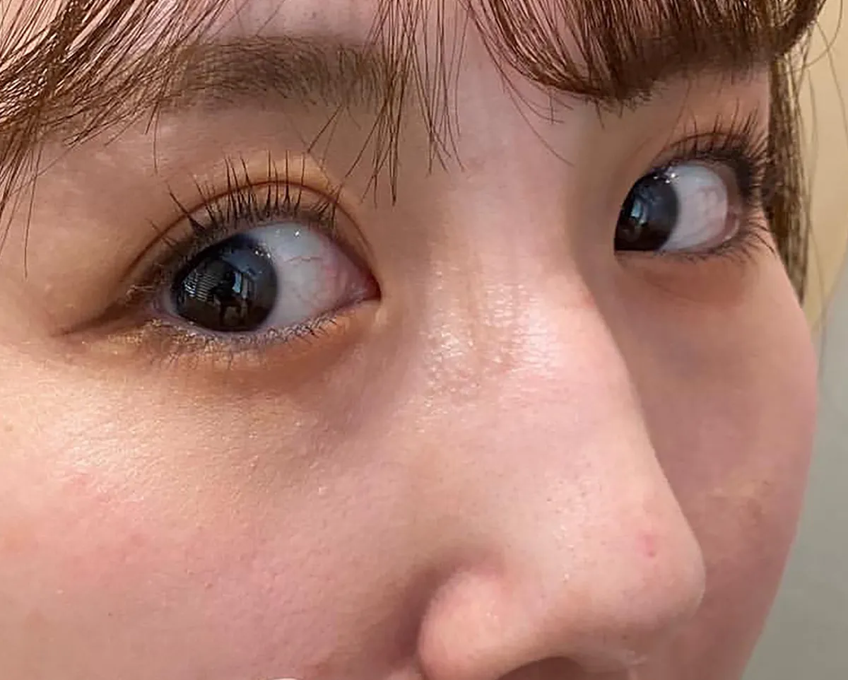 Tear Trough Hyaluronic Acid Before