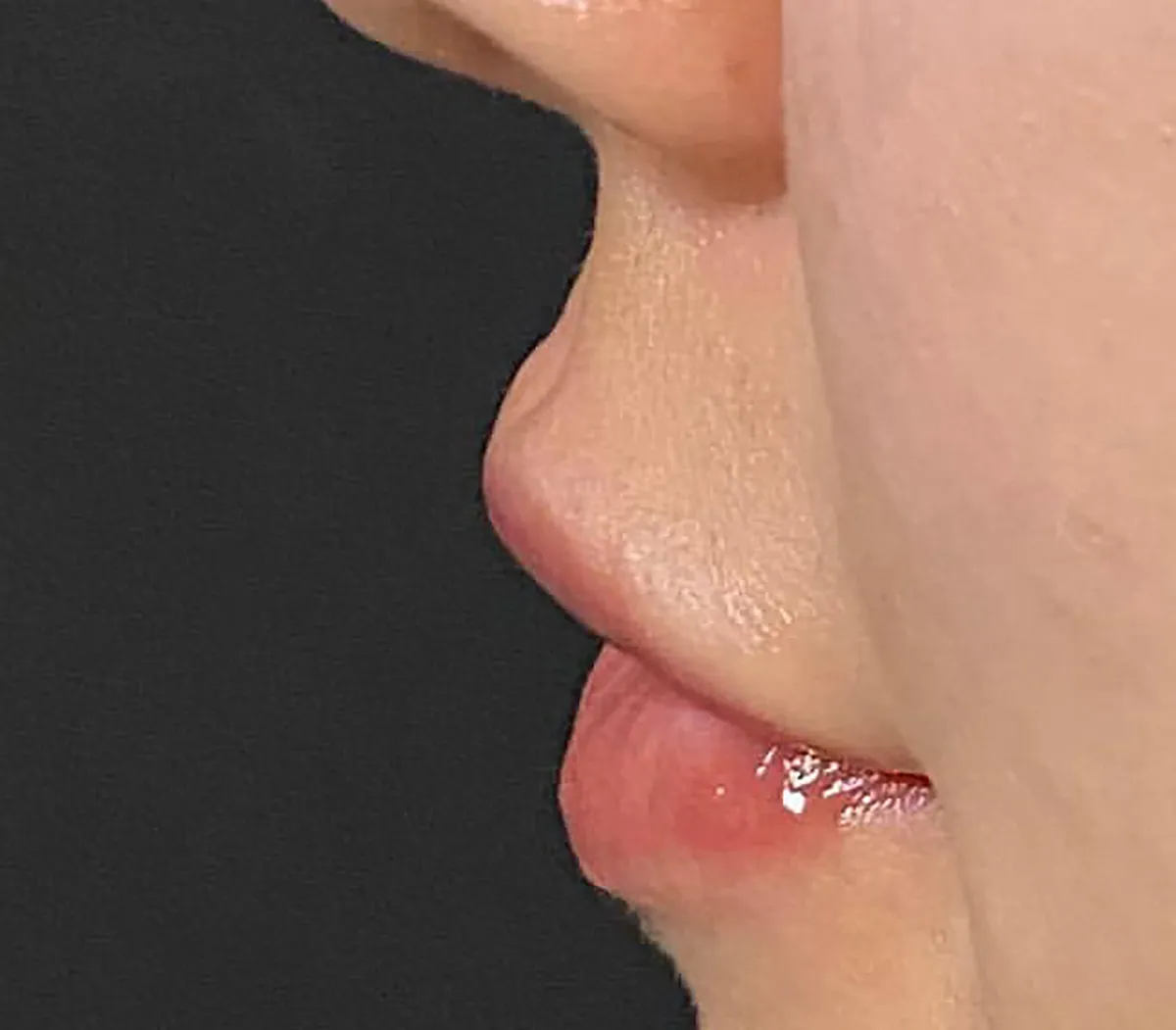 Philtrum Shortening Hyaluronic Acid Injection After