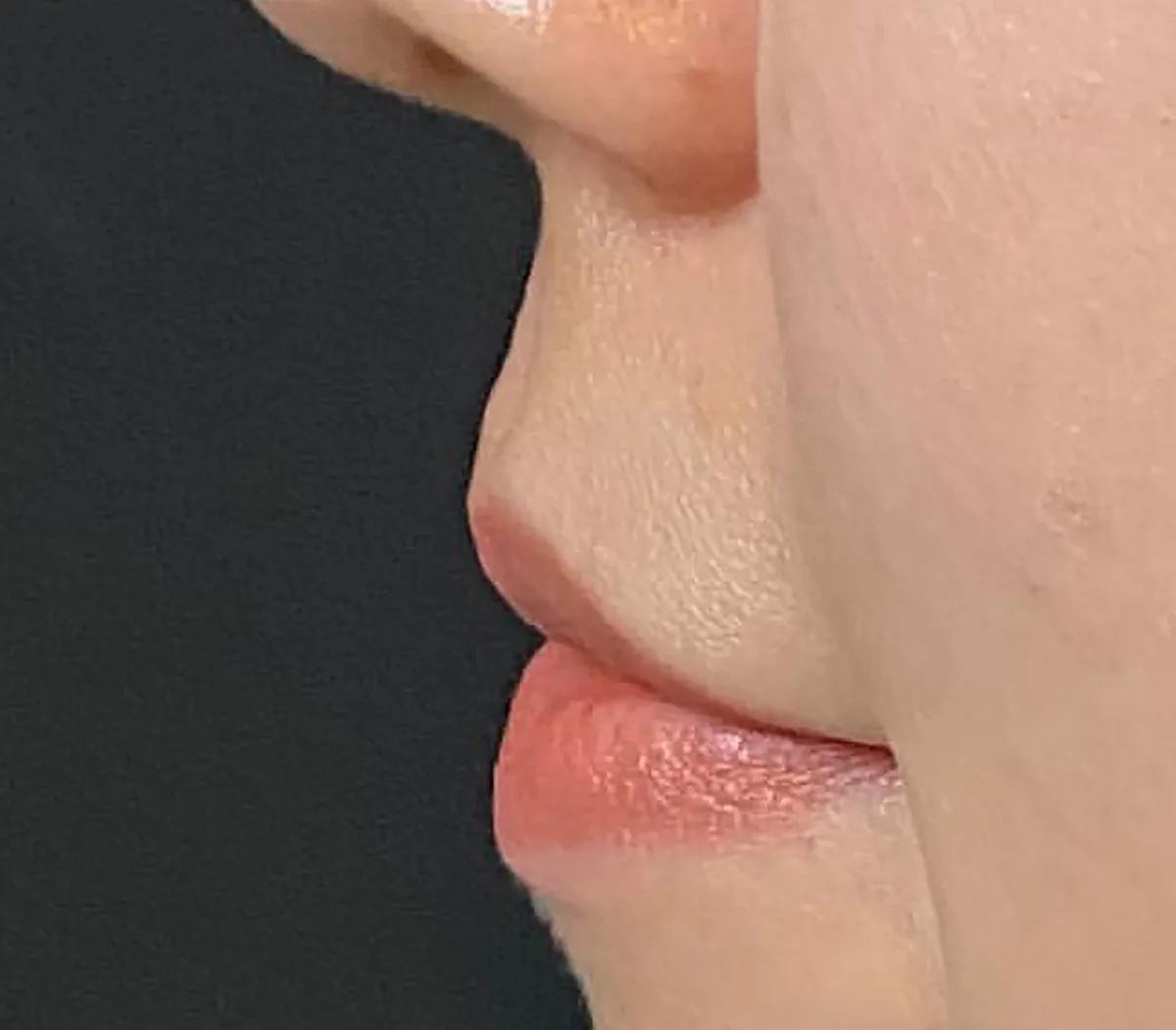Philtrum Shortening Hyaluronic Acid Injection Before