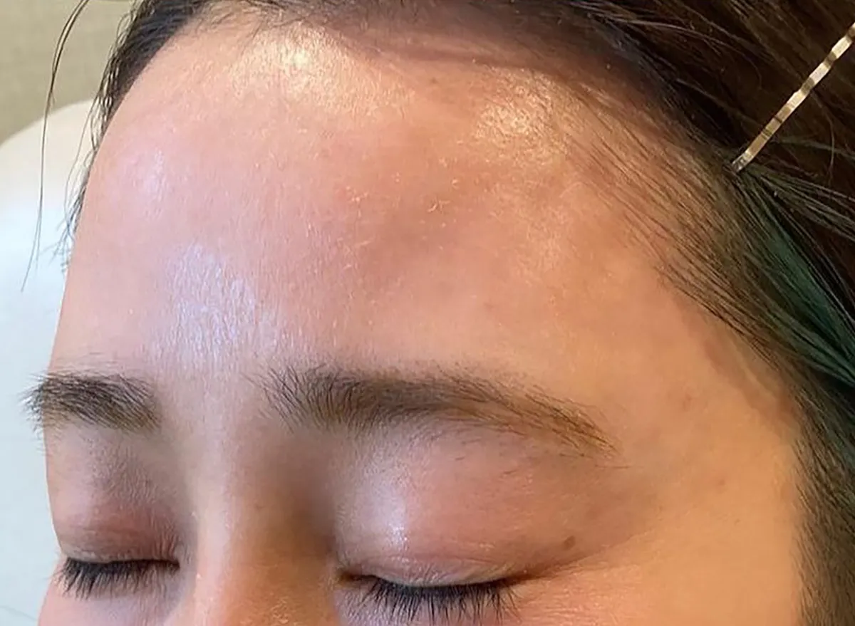 Above EyebrowsHyaluronic Acid Injection After