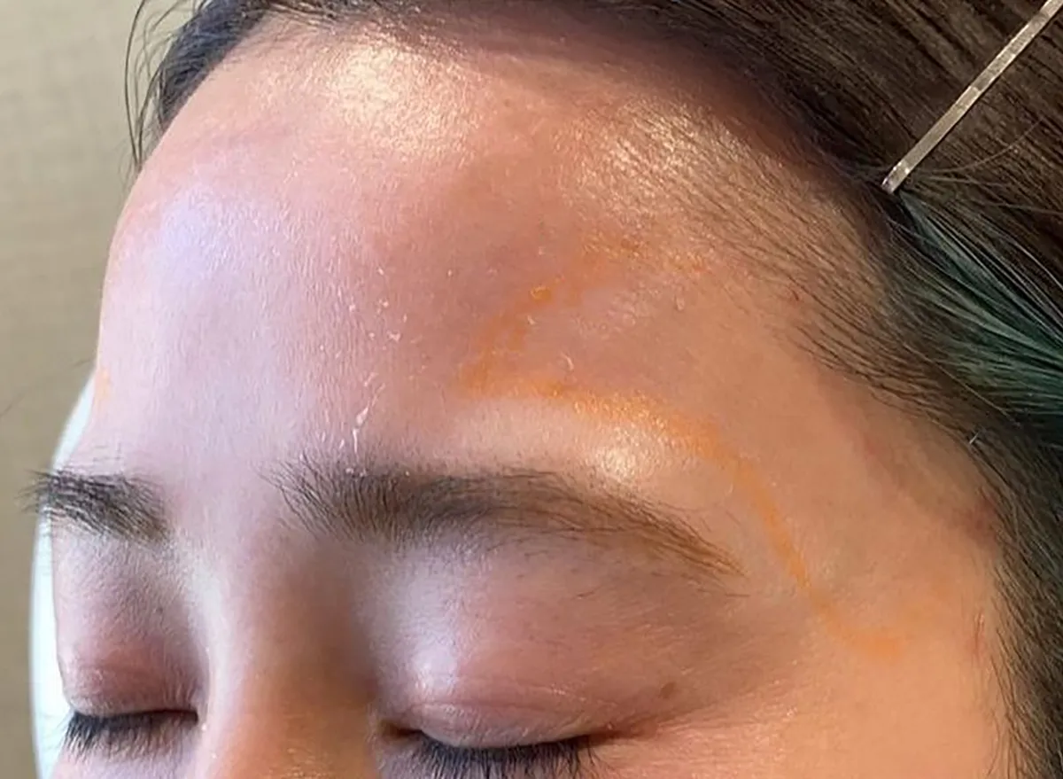 Above EyebrowsHyaluronic Acid Injection Before