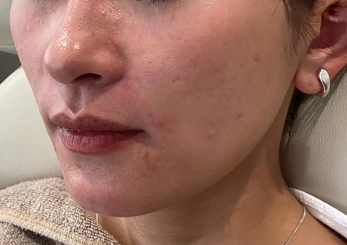 CheeksHyaluronic Acid Injection After