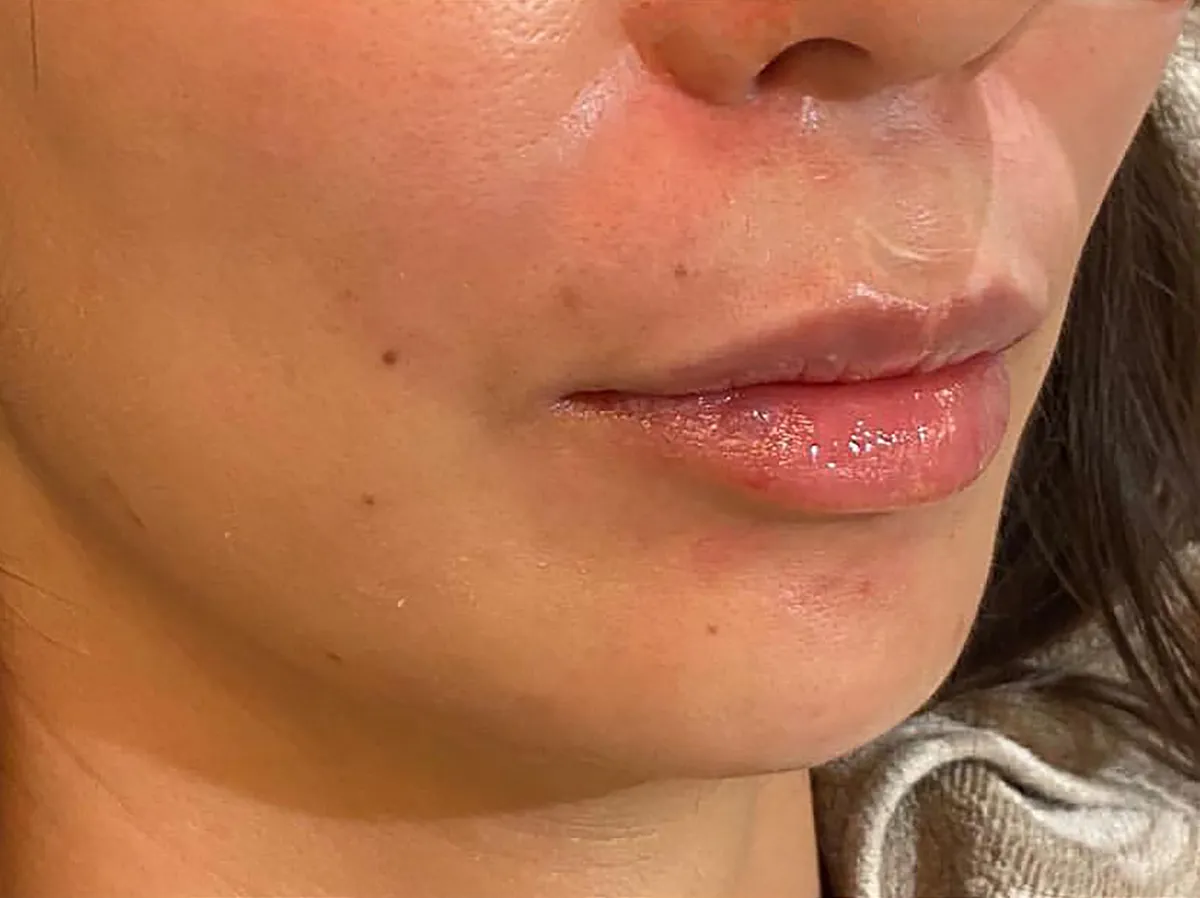Lower Face Hyaluronic Acid Injection After