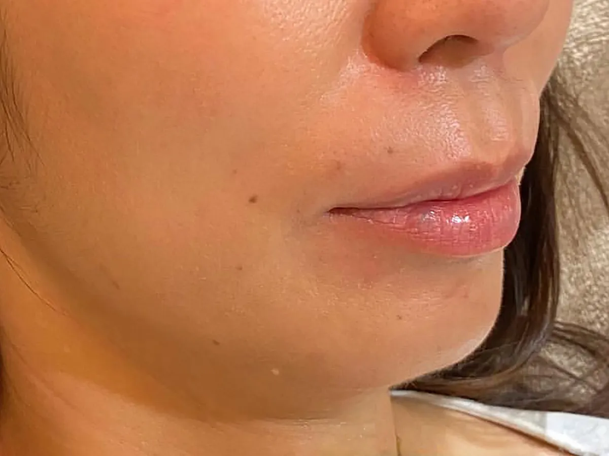 Lower Face Hyaluronic Acid Injection Before