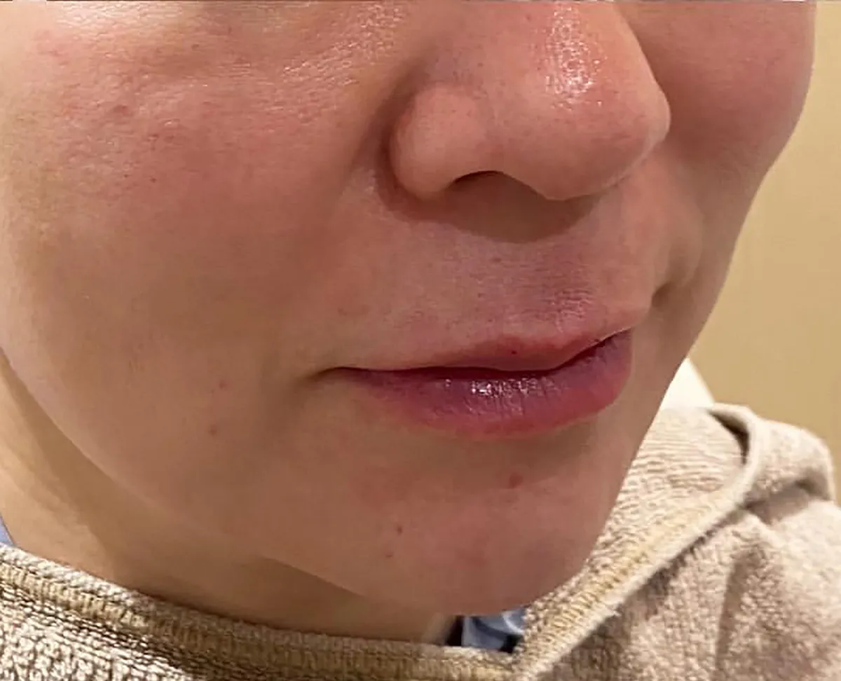 Lower Face Hyaluronic Acid Injection After