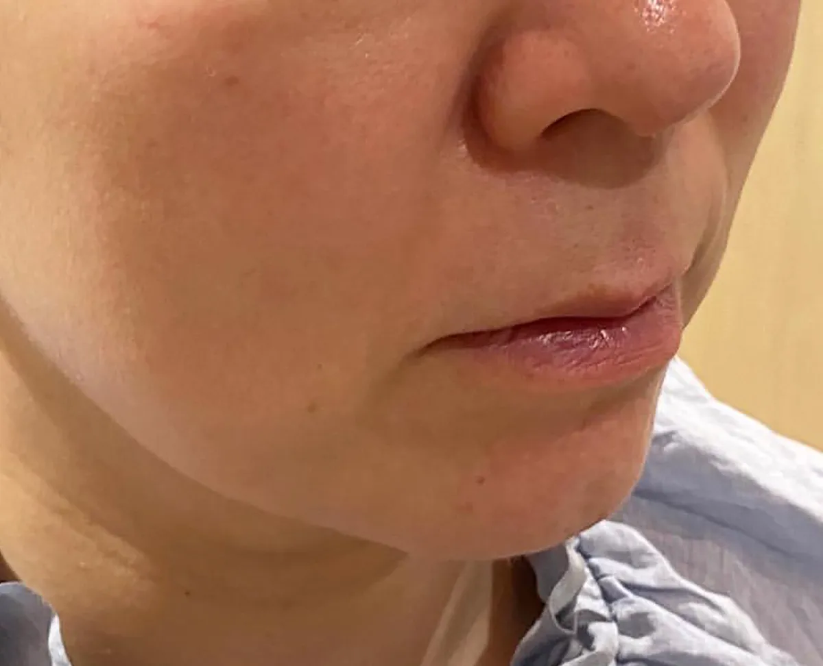 Lower Face Hyaluronic Acid Injection Before