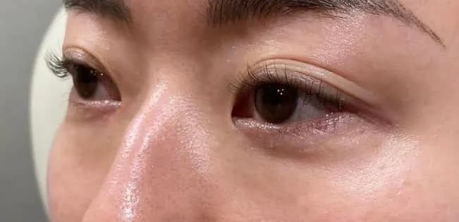 Tear Trough Hyaluronic Acid Before
