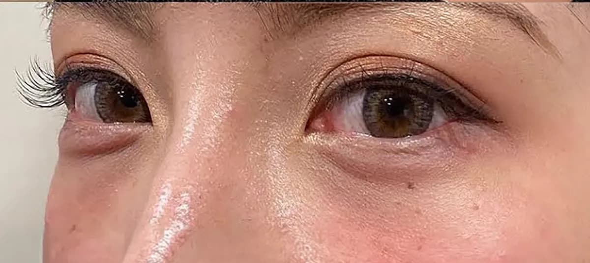 Tear Trough Hyaluronic Acid After