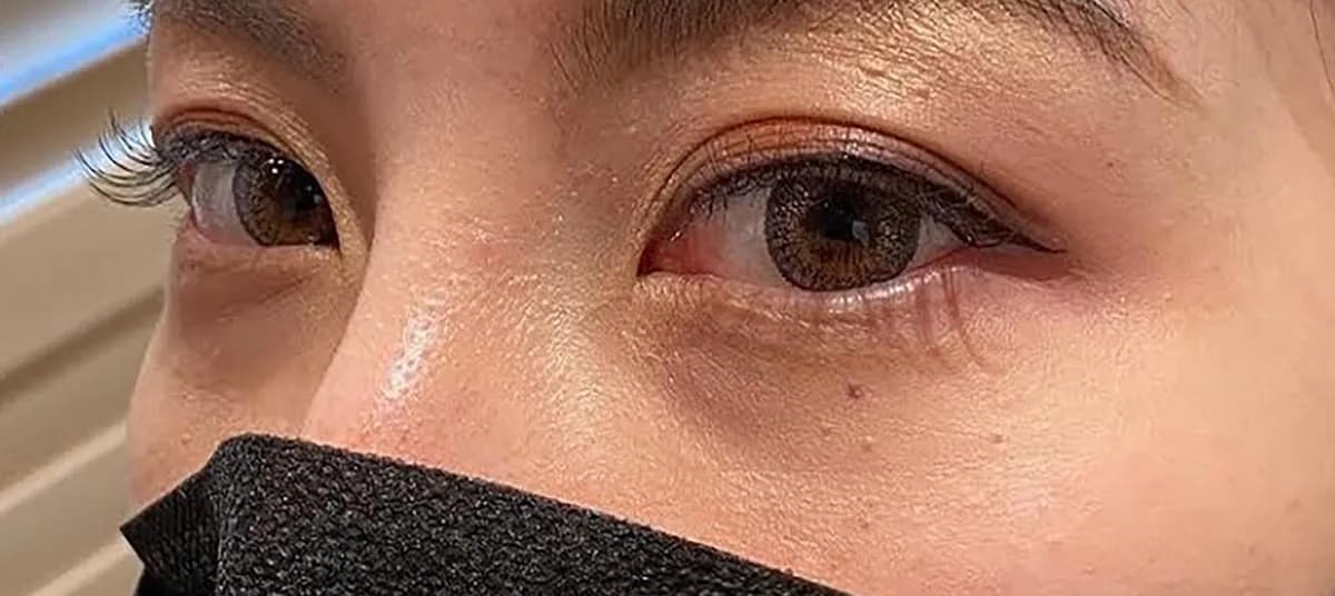 Tear Trough Hyaluronic Acid Before