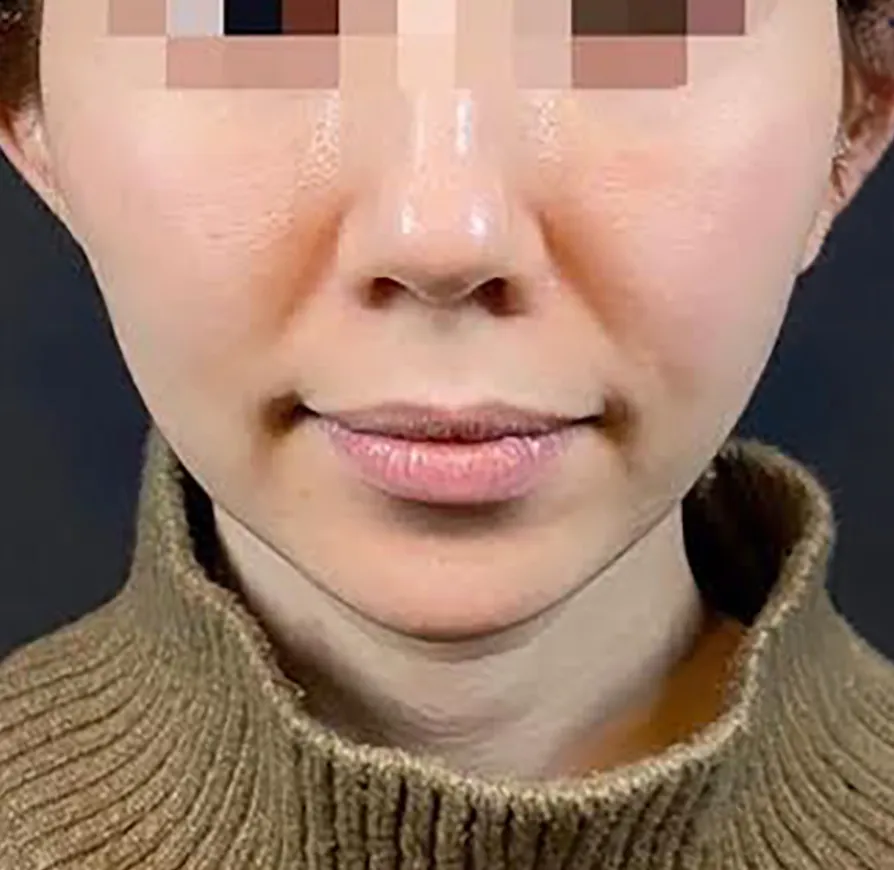 Combination Lift (HIFU + Thread) Before