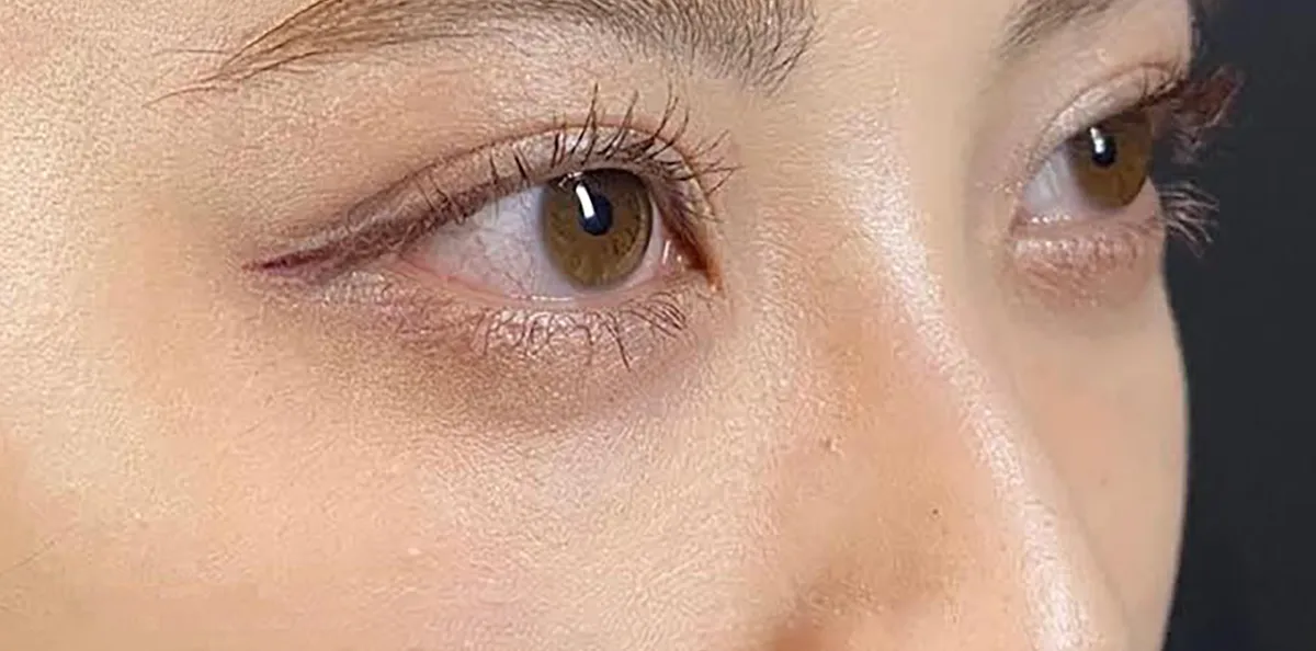 Lower Eyelid Fat Removal Surgery After