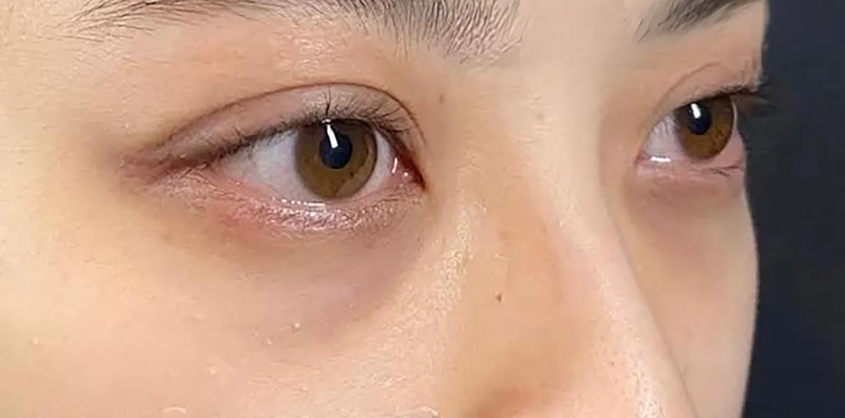 Lower Eyelid Fat Removal Surgery Before