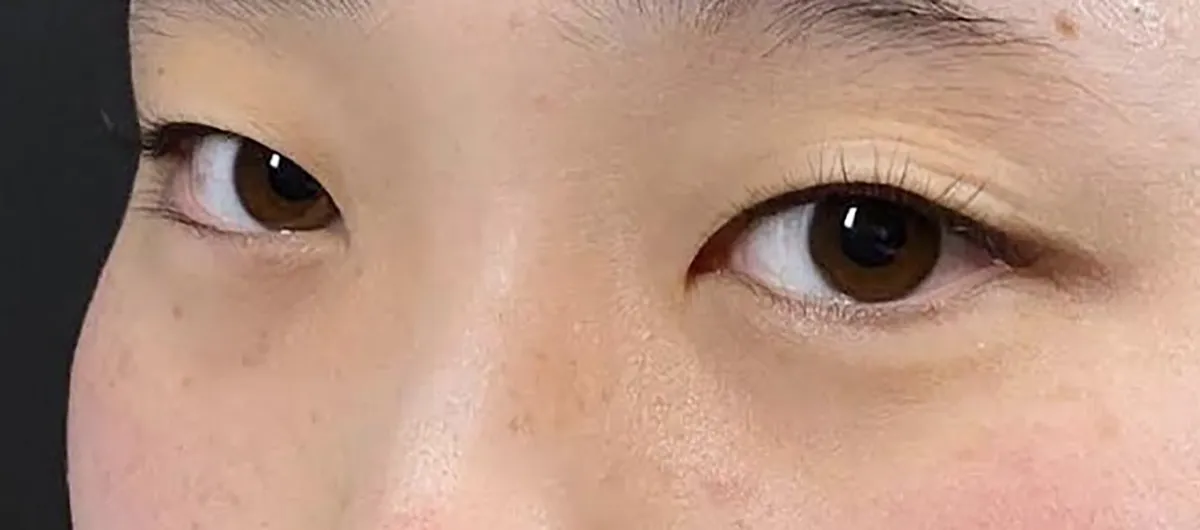 Rejuva Eyes Double (Eyelid) Before