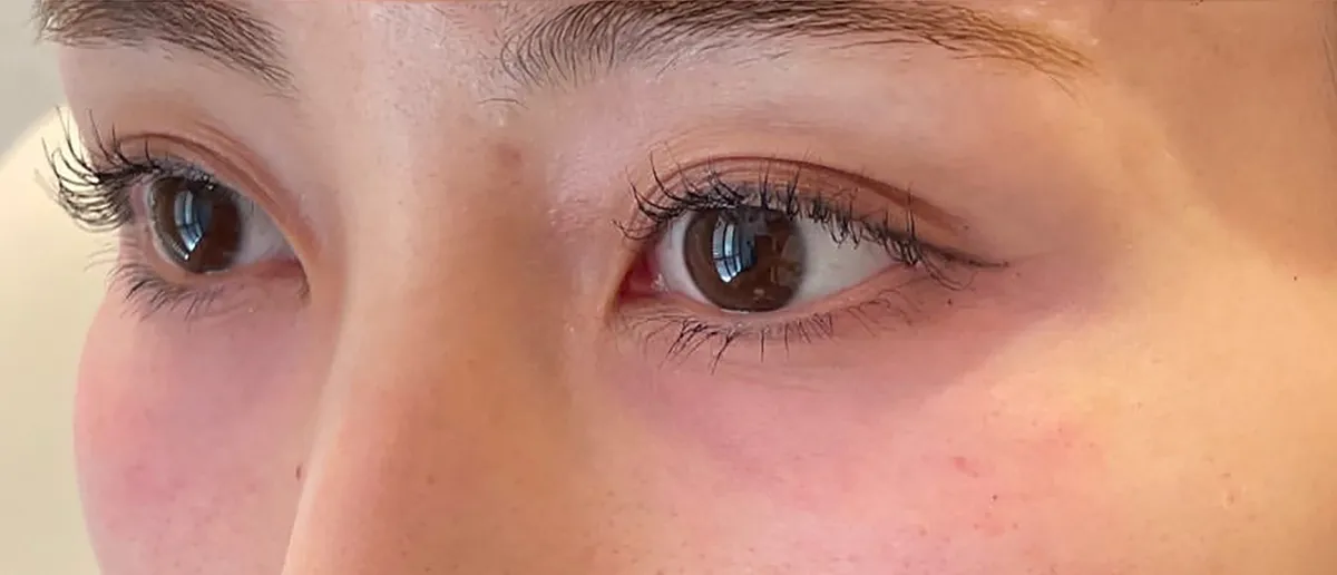 Under-Eye Baby Collagen Injection After