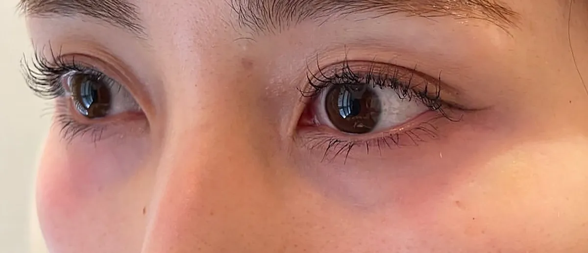 Under-Eye Baby Collagen Injection Before