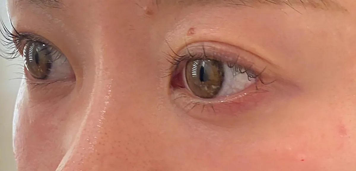 Under-Eye Baby Collagen Injection After
