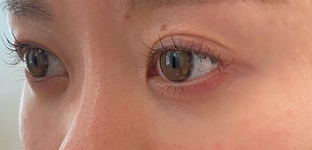 Under-Eye Baby Collagen Injection Before