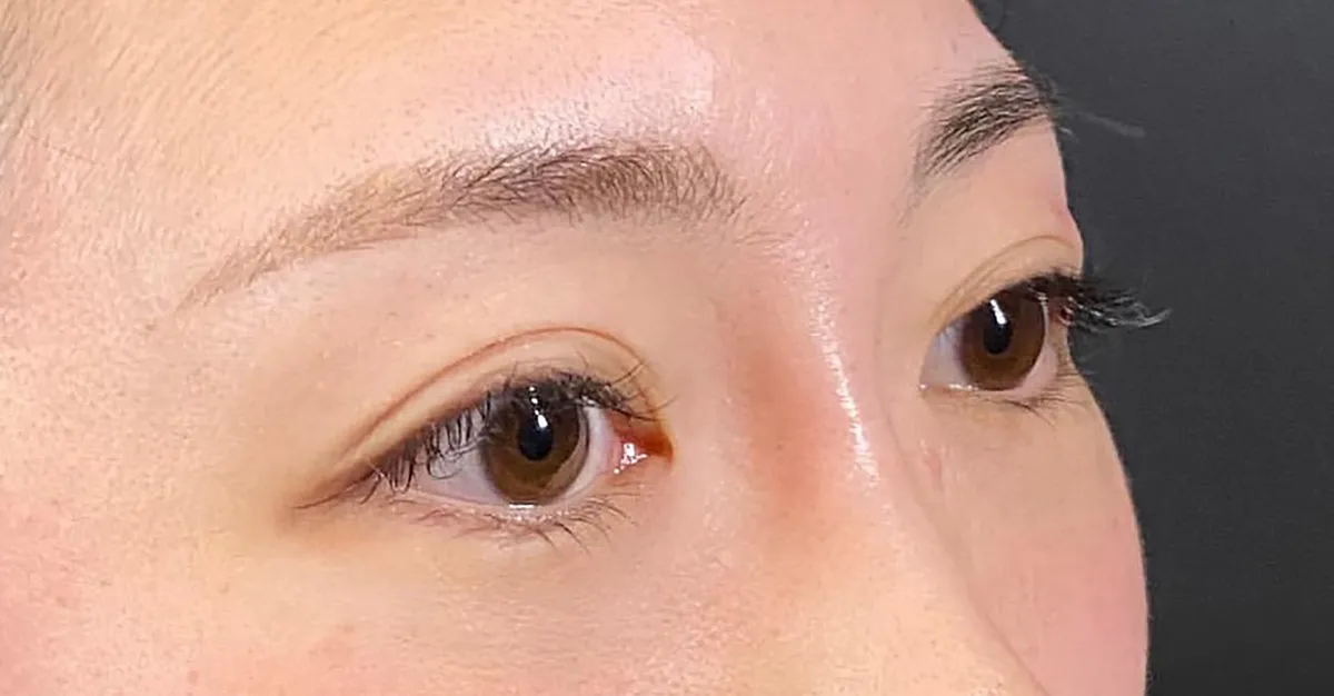 Nose Bridge Hyaluronic Acid After
