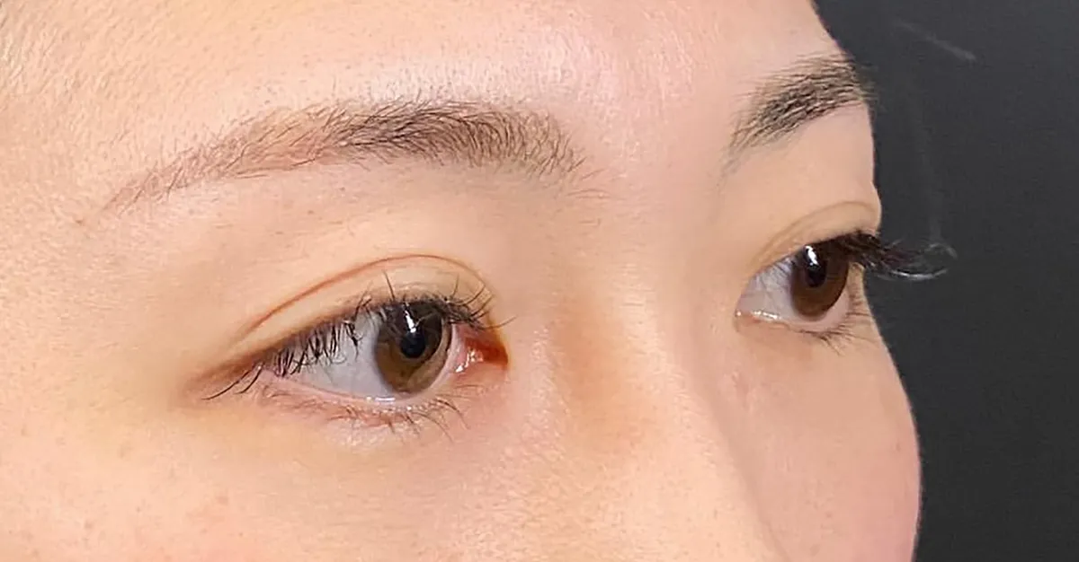 Nose Bridge Hyaluronic Acid Before