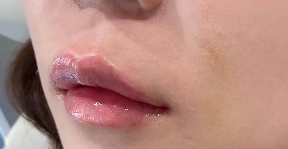 Philtrum Shortening (Botox + Filler) After
