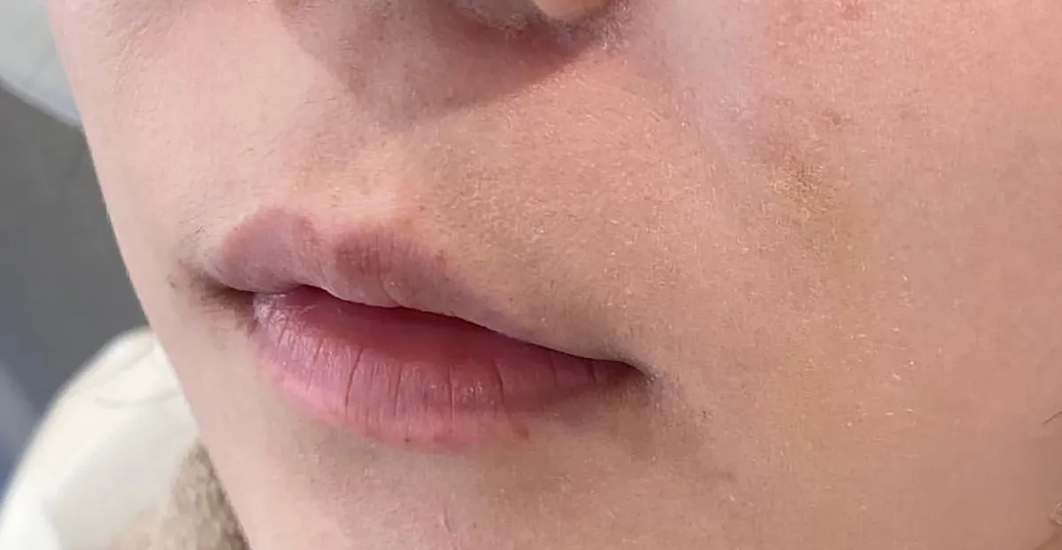 Philtrum Shortening (Botox + Filler) Before