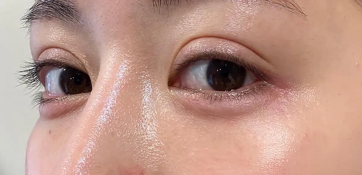 Tear Trough Hyaluronic Acid After
