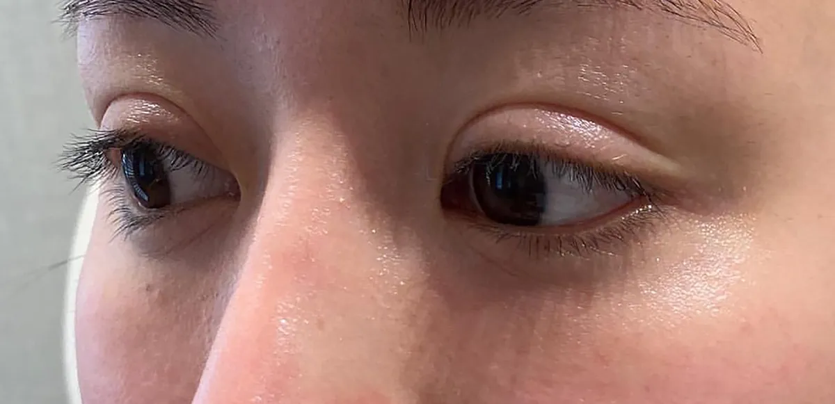 Tear Trough Hyaluronic Acid Before