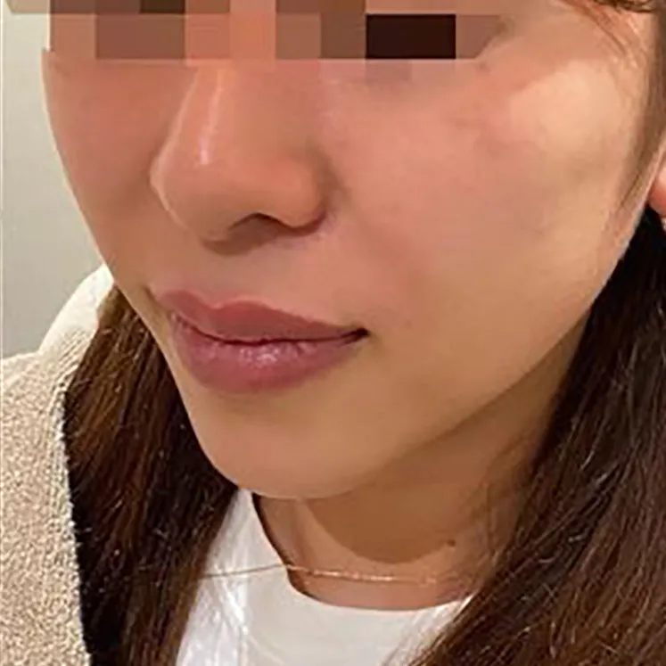 Full Face Hyaluronic Acid After