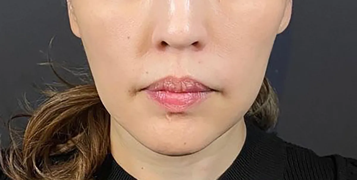 MW Dual Lift (Thread) Before