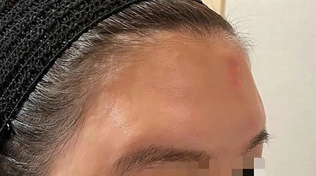 Forehead Hyaluronic Acid Before