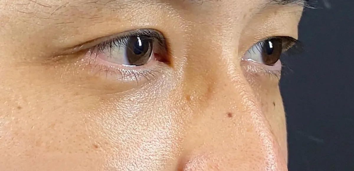 Lower Eyelid Fat Removal Surgery After