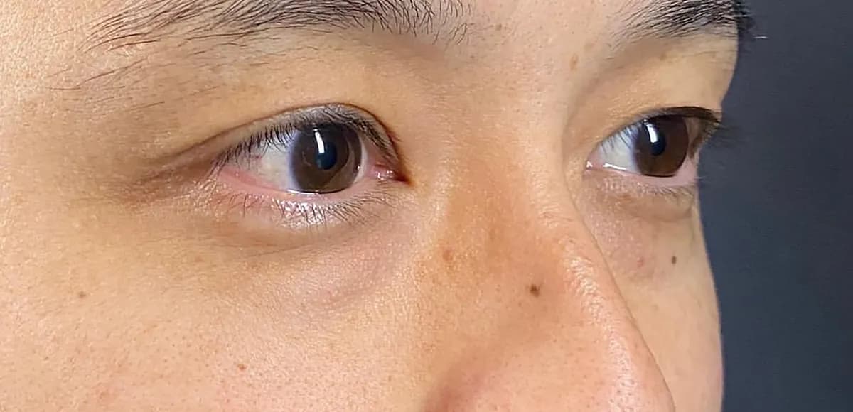 Lower Eyelid Fat Removal Surgery Before