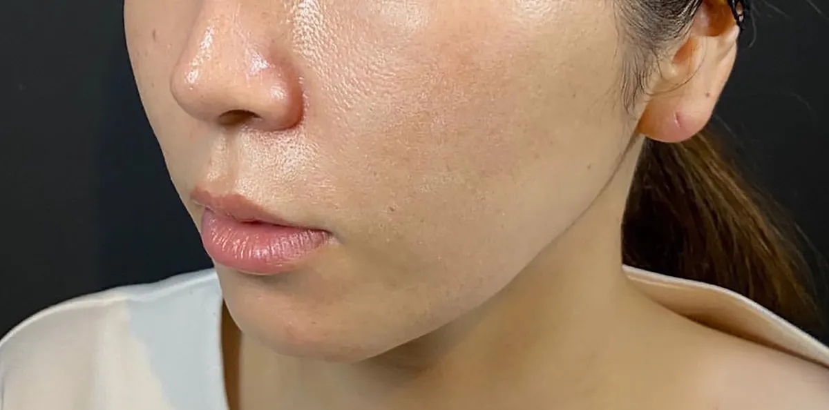 Mix Thread Lift After