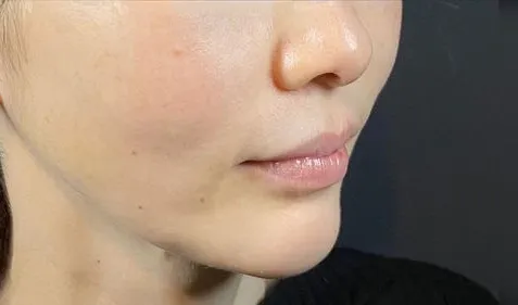 Mix Thread Lift After