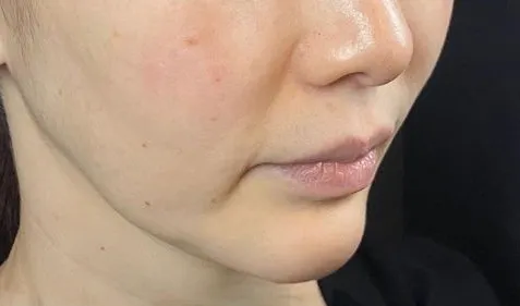 Mix Thread Lift Before