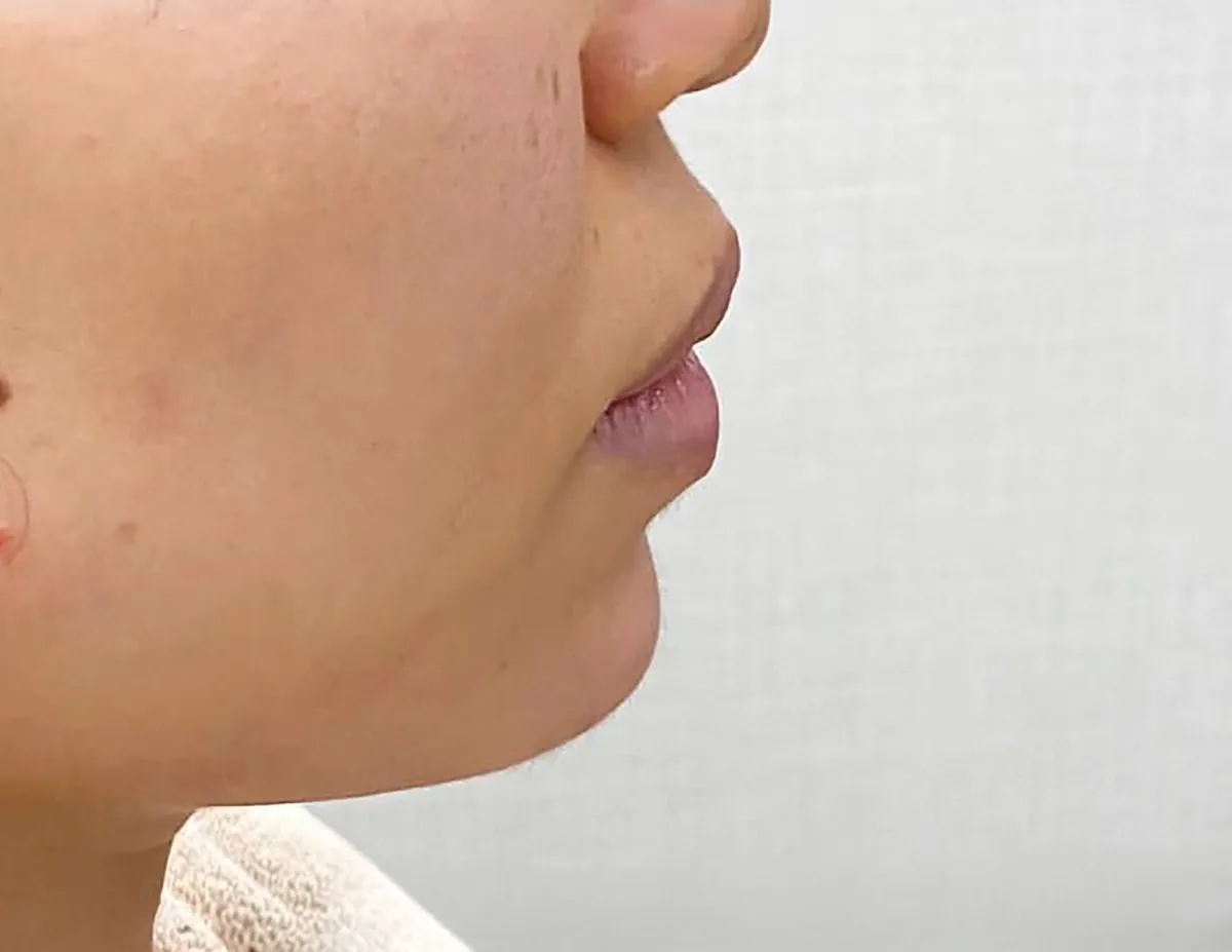 Philtrum Shortening + Lip Filler After