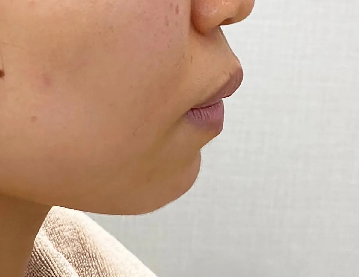 Philtrum Shortening + Lip Filler Before