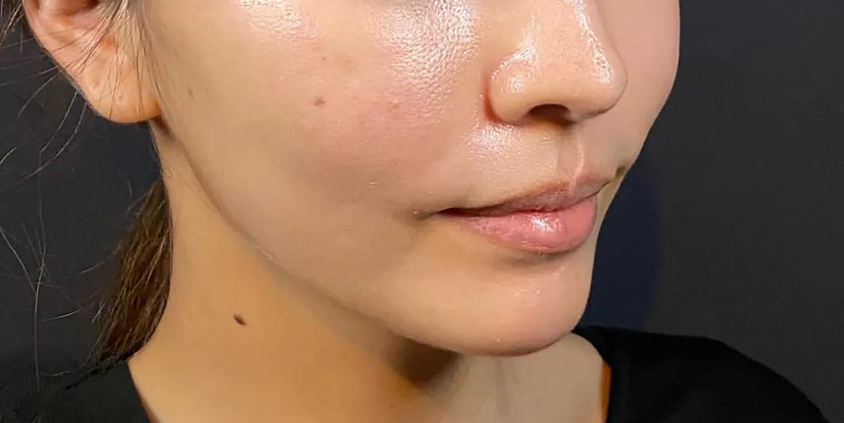 Mix Thread Lift After
