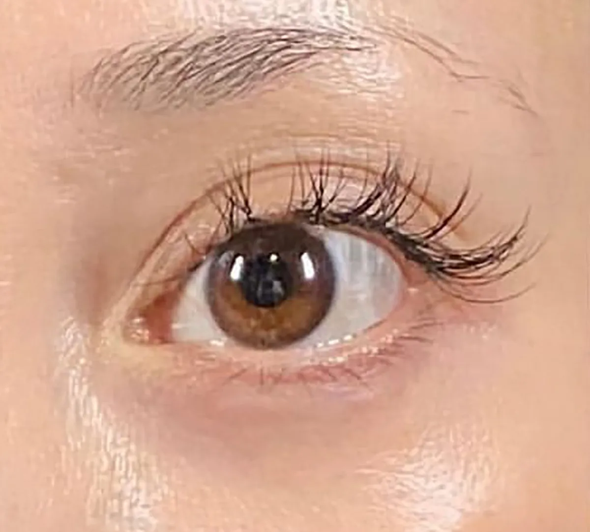Upper Eyelid Hyaluronic Acid After