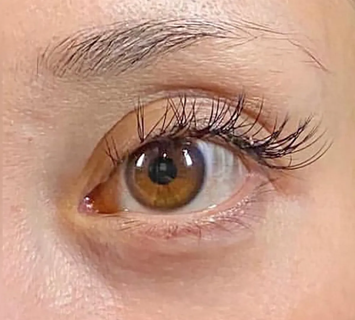 Upper Eyelid Hyaluronic Acid Before